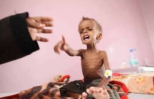 منظمة العمل ضد الجوع: 240 ألف يمني يعانون من نقص الغذاء 