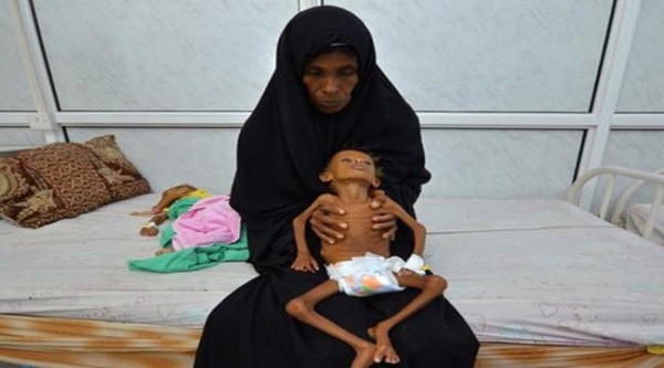 يونيسف: مليونا طفل يمني يعانون من سوء التغذية الحاد