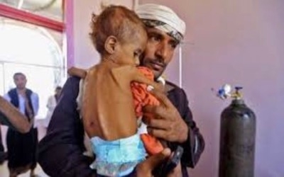 الصحة العالمية: 15 ألف طفل يمني يعانون من سوء التغذية الحاد الوخيم