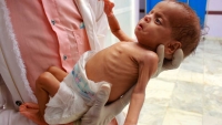 أطفال اليمن "يموتون كل ساعة".. أجساد هزيلة شاهدة على سنوات الدمار