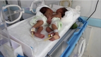 نجاح عملية فصل التوأم السيامي اليمني في أحد مستشفيات الأردن