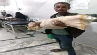 سلطات تعز توقف طاقما طبيا على خلفية وفاة الطفلة "صفية محمد"